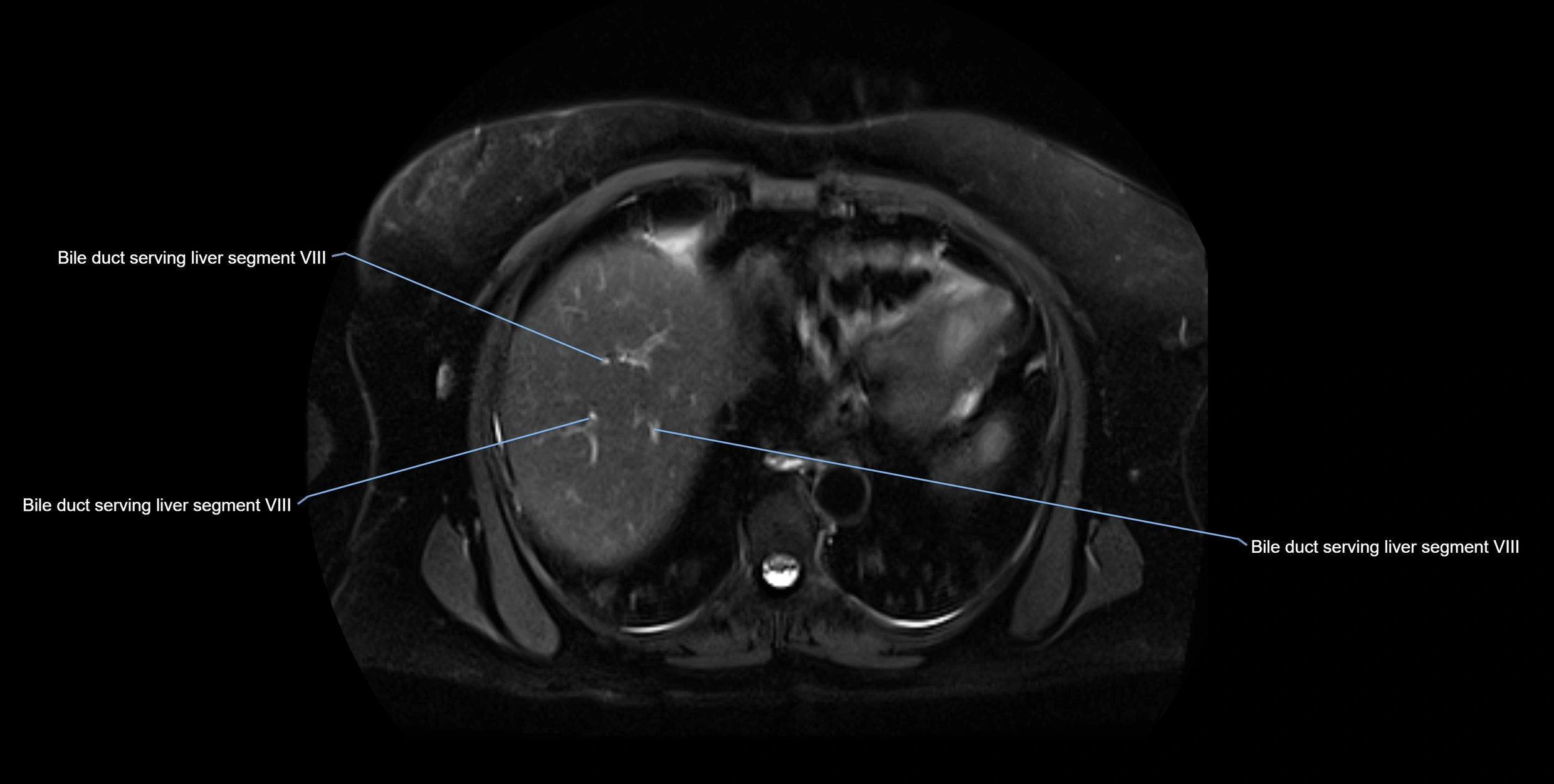 MRI MRCP axial cross sectional anatomy 3T radiology  image-img-10001-00006.webp
